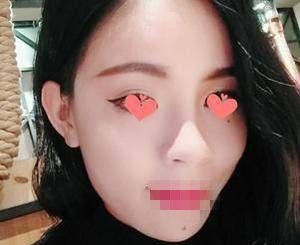 分享我在洛阳毛大夫医疗的面部脂肪填充日记 短短一个月后 面若桃花楚楚动人 图2