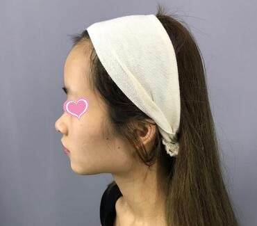 看了我在锦州斯美诺整形医院做的肋软骨+膨体鼻综合效果后 小姐妹们说也要去做同款的!
