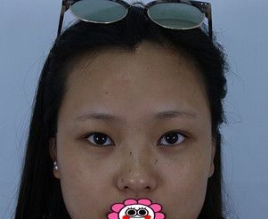被常德伊丽莎白双眼皮案例种草了,半年前让卢开锐给我割了双眼皮