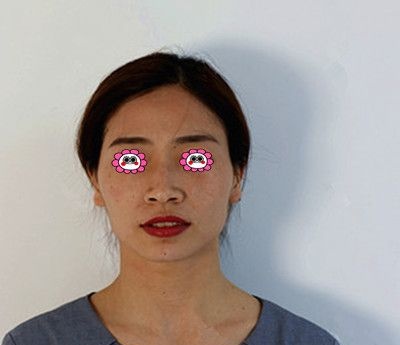 衡阳美莱为体重偏瘦的我做面部脂肪填充,效果令我很满意