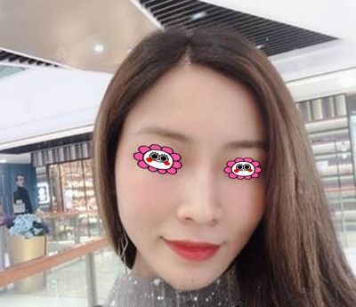 衡阳美莱为体重偏瘦的我做面部脂肪填充,效果令我很满意 图2