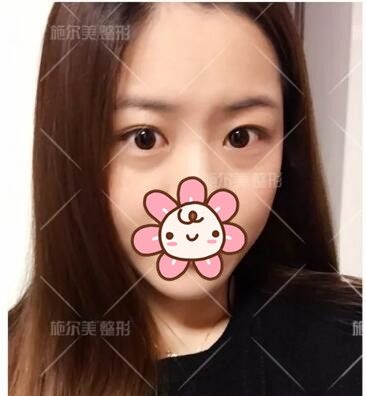 看常州施尔美东方芭比眼案例效果不错 也去面诊做了眼皮+内眦开大告别有肿眼泡的内双眼还改善了两眼间距