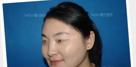 一开始也担心瘦脸除皱瘦脸副作用的我,没想到在常州曙光医生亲诊下尝试了一次居然想定期注射