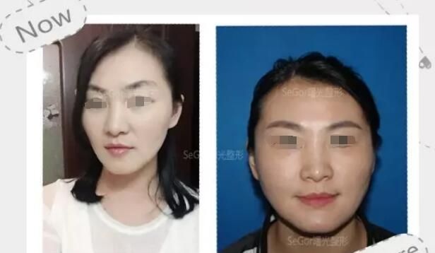 一开始也担心瘦脸除皱瘦脸副作用的我，没想到在常州曙光医生亲诊下尝试了一次居然想定期注射 案例图2