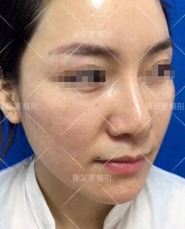 典型油性肌肤的她到常州施尔美做了微针美容,改善了痘痘、毛孔粗大等问题