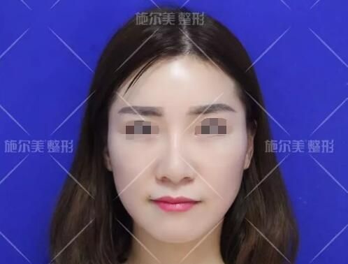 典型油性肌肤的她到常州施尔美做了微针美容，改善了痘痘、毛孔粗大等问题 案例图2