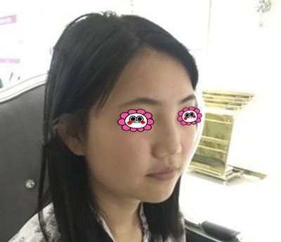 半年前在常德德美找符恒做肋软骨隆鼻,秀一波我的侧颜杀
