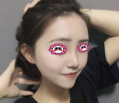 半年前在常德德美找符恒做肋软骨隆鼻，秀一波我的侧颜杀 案例图2