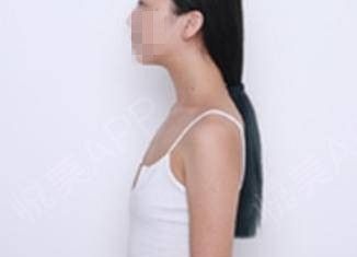 我的假体隆胸回忆录- 在洛阳华美丰胸后我总算有机会当上了大女人