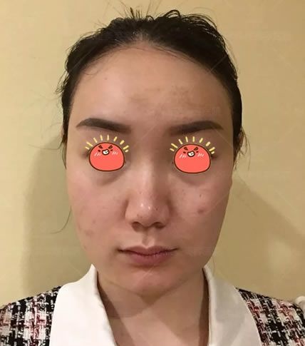 种草很久的埋线提升手术,终于在绍兴维美整形李俊霞这儿做了全面部线雕,现分享我的线雕日记