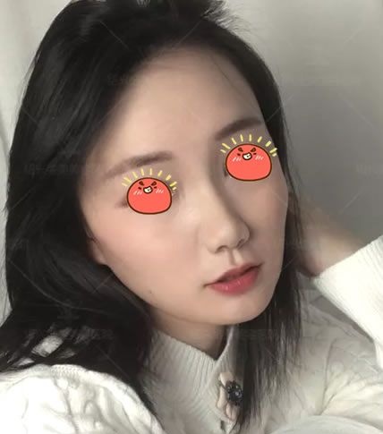 种草很久的埋线提升手术,终于在绍兴维美整形李俊霞这儿做了全面部线雕,现分享我的线雕日记 图2
