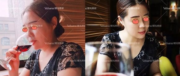 50岁的我不服老,来嘉兴曙光做了祛眼袋和面部4D线雕提升术,一个月效果出炉 图2