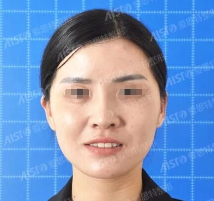 都说无锡爱思特高飞是亚太实力抗衰医生看过对比照效果后立马预约做了PPDO线雕提升面部年轻化项目