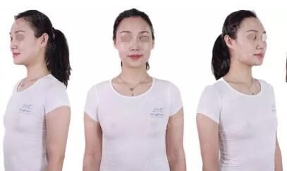 本身就不大的胸生宝宝哺乳后更平了还有些垂 老公带我到无锡爱思特做隆胸手术恢复自信的我
