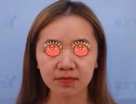 找了温州艺星这家治痘祛痘坑痘印比较好的医院做了激光祛痘套餐,从此不再做口罩女