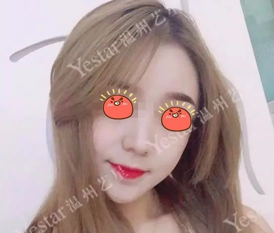 找了温州艺星这家治痘祛痘坑痘印比较好的医院做了激光祛痘套餐,从此不再做口罩女 图2