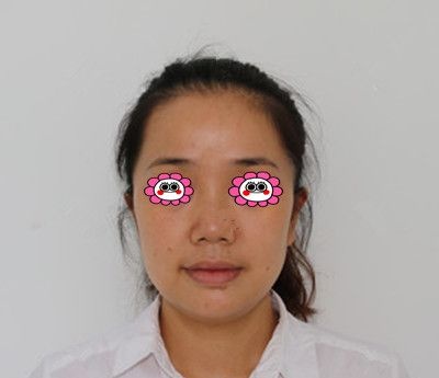 在衡阳美莱做完面部线雕4个月后打卡,原来“甜颜”比“蜜语”更重要
