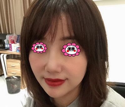 在衡阳美莱做完面部线雕4个月后打卡,原来“甜颜”比“蜜语”更重要 图2