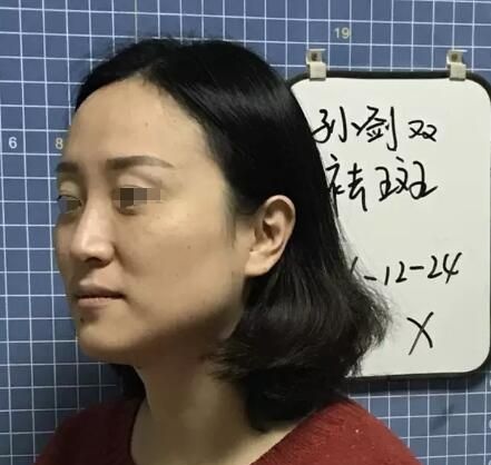 同事在无锡爱思特的祛斑效果打破我的疑虑，预约范红梅医生做了VISIA皮肤检测后体验大Q祛斑效果