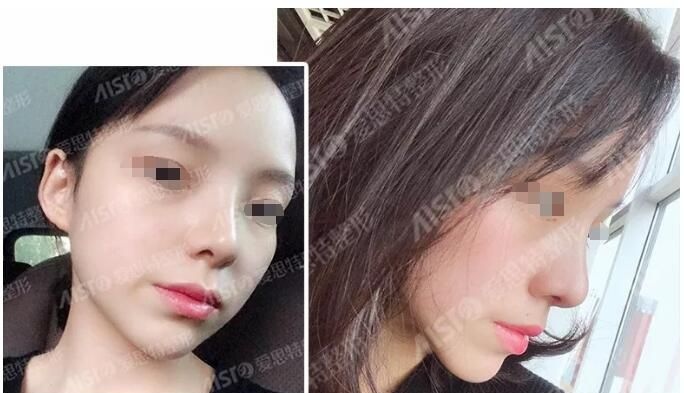 幸运的赶上无锡爱思特征集鼻整形案例 别人花5万元的鼻综合我只花了0元还是欧阳黎平和郭晔医生联合坐诊 图2