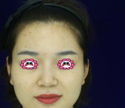 闺蜜陪我到常德伊丽莎白做面部脂肪填充三个月后,决定找卢开锐做双眼皮