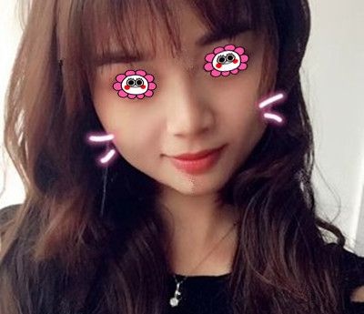 闺蜜陪我到常德伊丽莎白做面部脂肪填充三个月后,决定找卢开锐做双眼皮 图2