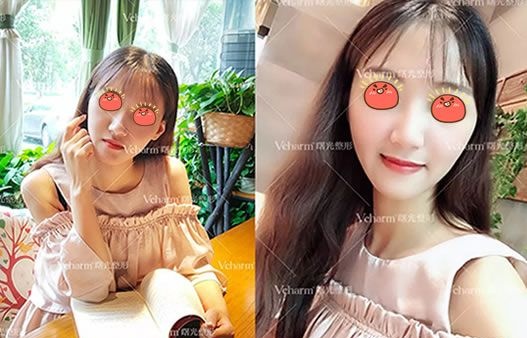 我就想微微整一下,于是我选择嘉兴曙光注射乔雅登玻尿酸进行面部填充提升 图2