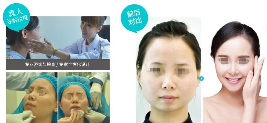 无锡爱思特get自拍上镜小V脸仅一招：小V脸提升术=+玻尿酸+胶原蛋白线性提拉 快来围观术后效果