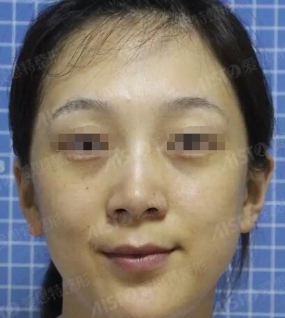 气温升高脸上油光满面毛孔粗大有黑头?看我选择无锡爱思特15分钟的注射巨补水摆脱油腻腻
