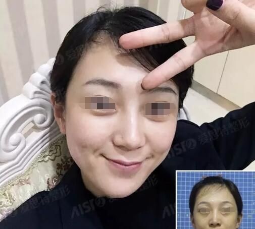 气温升高脸上油光满面毛孔粗大有黑头?看我选择无锡爱思特15分钟的注射巨补水摆脱油腻腻 图2