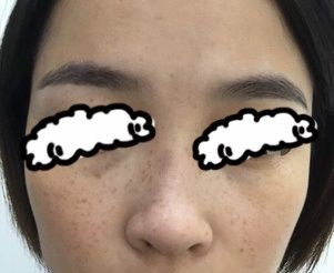 记录在青海西宁时光医院激光祛斑一个月恢复过程,看我如何摆脱麻子脸