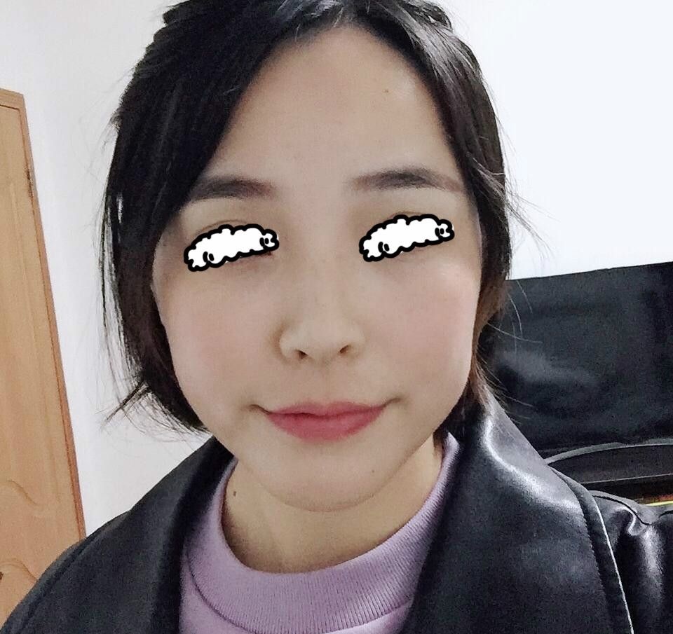 记录在青海西宁时光医院激光祛斑一个月恢复过程,看我如何摆脱麻子脸 图2