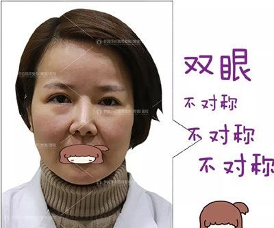 半年前我趁着活动在常德伊丽莎白做了全切双眼皮修复,效果怎么样看图说话