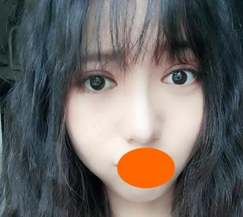 面诊上饶尚美整形刘育凤后才知道新月型双眼皮更适合我脸型 案例图2
