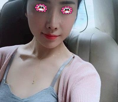 有胸就是任性,在衡阳美莱做完250cc的曼托假体丰胸后改变的不止是size…