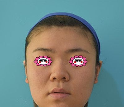 湘潭雅美做膨体隆鼻两年了，较近打算再去做个鼻翼缩小术