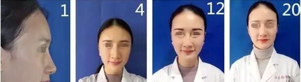 经过专业的检验和血压测量一切合格后 淮安华美高主任用自身大腿内侧的脂肪来做移植填充体验日记公开 图2