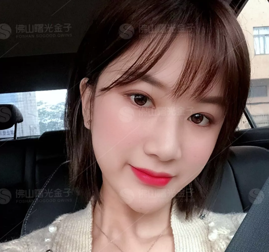 公开我去佛山曙光金子找何宜新院长做童颜线雕埋线提升术后一周的恢复过程图片 图2