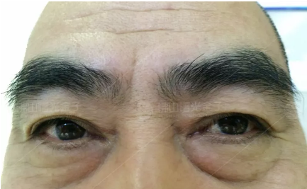 说说我花6800元去佛山曙光金子找甘国端院长做3分钟极速祛眼袋的亲身经历和感受