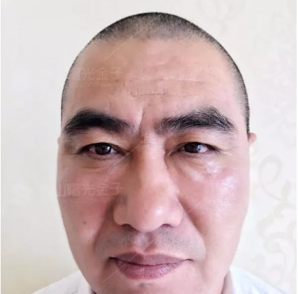 说说我花6800元去佛山曙光金子找甘国端院长做3分钟极速祛眼袋的亲身经历和感受 图2