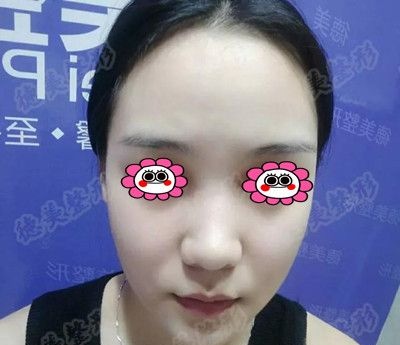 先不说娄底德美整形怎么样,直接上传某网红找符恒做鼻综合1个月的恢复照