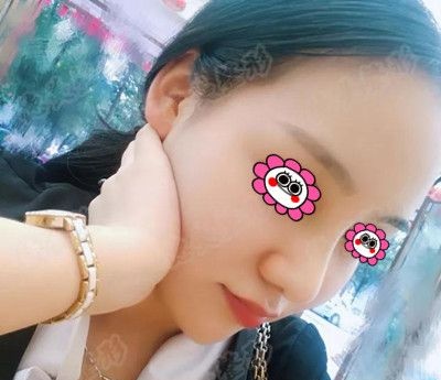 先不说娄底德美整形怎么样,直接上传某网红找符恒做鼻综合1个月的恢复照 图2