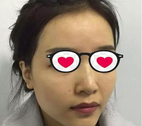 感觉注射玻尿酸隆鼻很麻烦就找呼和浩特京美朱京成做了鼻综合隆鼻手术 恢复的贼拉快