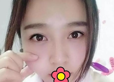 感觉注射玻尿酸隆鼻很麻烦就找呼和浩特京美朱京成做了鼻综合隆鼻手术 恢复的贼拉快 图2