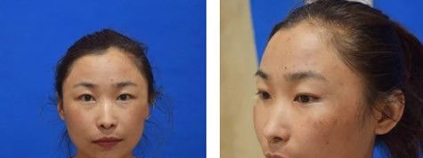 呼和浩特京美特邀医师刘文阁做M22激光祛斑多少钱?他给我做王者之冠三次就出效果了