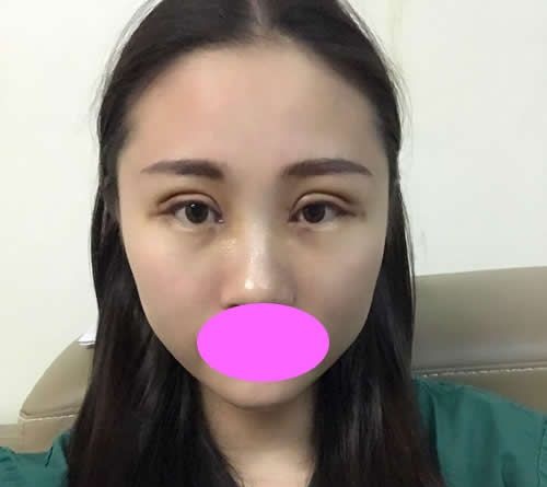 同事都说我找九江星瑞美刘志强割双眼皮+开眼角一个月后的效果很自然