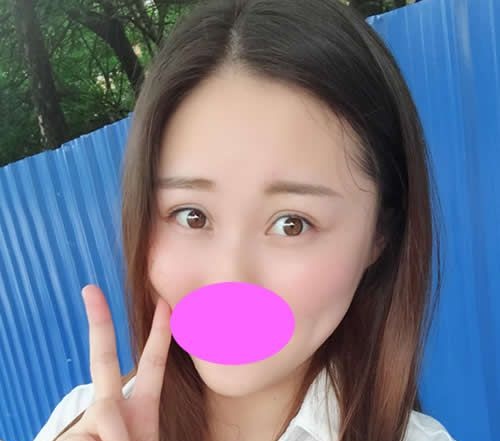 同事都说我找九江星瑞美刘志强割双眼皮+开眼角一个月后的效果很自然 图2