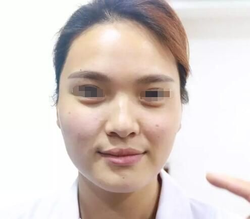 盐城东方主任王武坤揭秘半边脸注射对比效果肤色明显提亮 案例图2