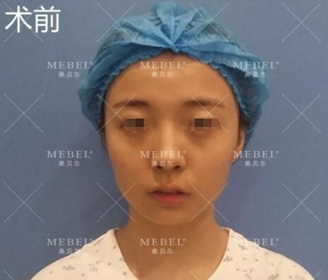 不甘心做路人面诊扬州美贝尔张成春医生做了硅胶体垫鼻梁+肋软骨塑鼻头+下巴整形 不到8000元的术后效果真的值了