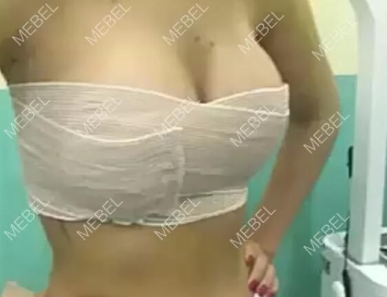32a的扬州本地姑娘到美贝尔做了自体脂肪移植丰胸术后成活不错 三个月穿比基尼已经有沟儿了